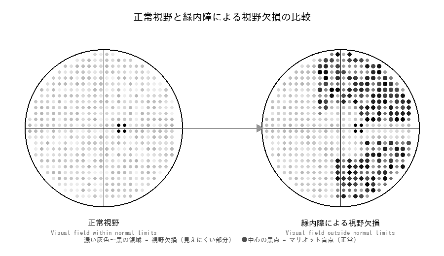 正常視野と緑内障による視野欠損の比較図。左が正常視野、右が緑内障による視野欠損を示す。
