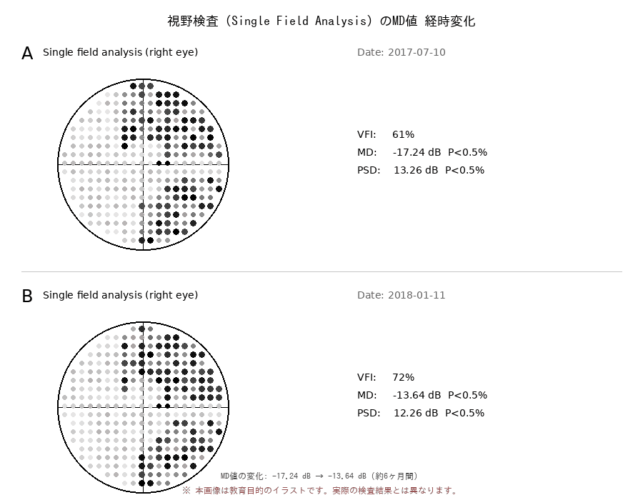 視野検査（Single Field Analysis）のMD値の経時変化。2回の検査でMD値が-17.24dBから-13.64dBに変化した例。